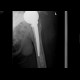 Scrotal hernia: X-ray - Plain radiograph
